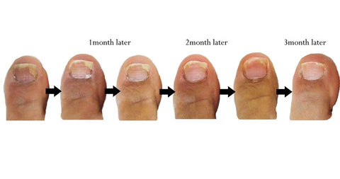 Why Is Toenail Fungus So Difficult to Treat? | University Hospitals